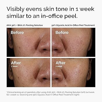 Solution de Peeling AHA 30% + BHA 2% - Soin Exfoliant